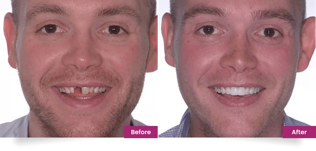 before after slider