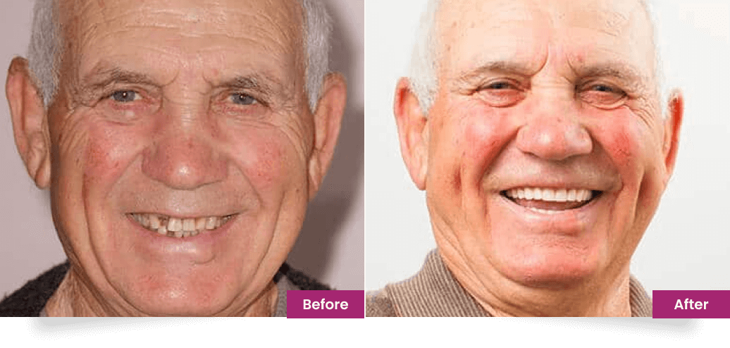 before after slider